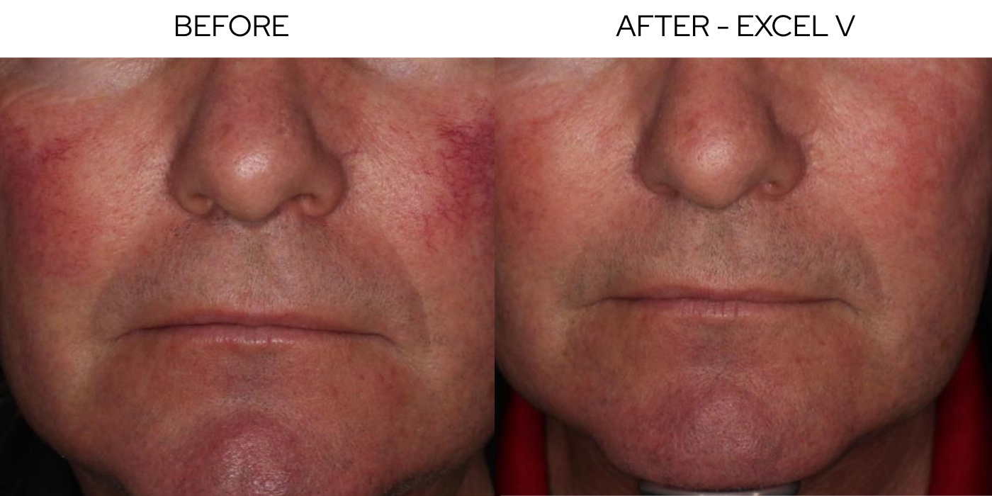 Before and After Result