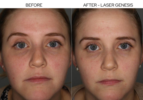 Before and After Result