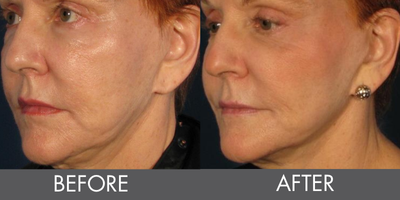 Thermage before and after