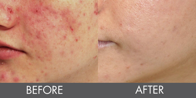 Excel V Before and after