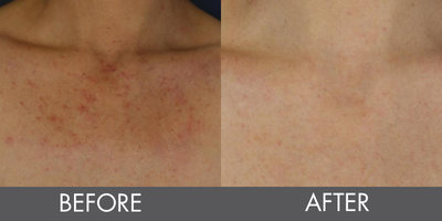 Excel V Before and after